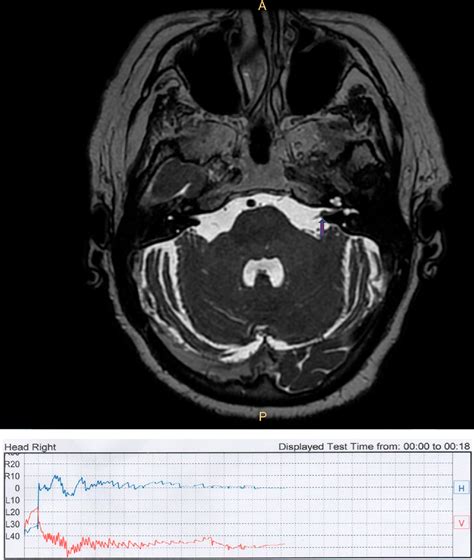 Paroxysmal Positional Nystagmus in Acoustic Neuroma Patients