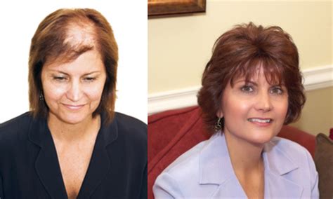 Partial Wigs: The Perfect Solution for Hair Loss