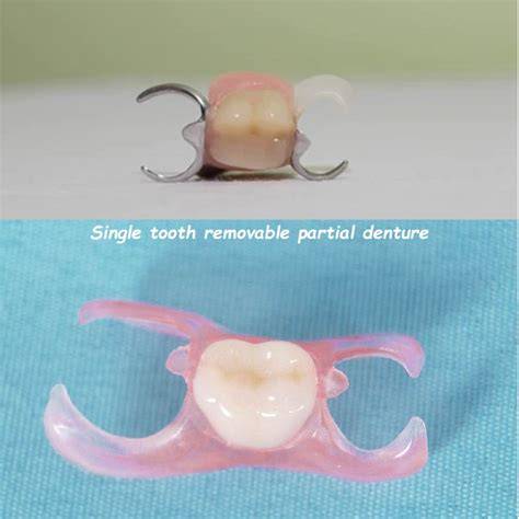 Partial denture for one molar.  A removable partial denture (RPD) is a prosthes...
