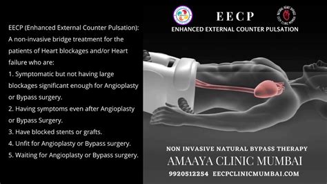 Read Online Passing On Bypass Using External Counterpulsation And Fda Cleared Alternative To Treat Heart Disease Without Surgery Drugs Or Angioplasty By George J Juetersonke