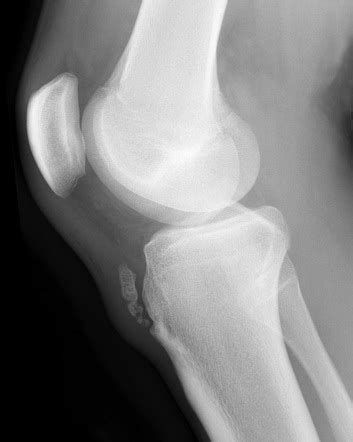 Patellar sleeve fracture Radiology Reference Article