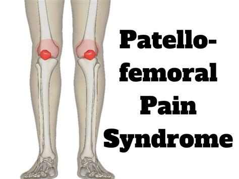 Patellofemoral Pain Syndrome (PFPS) Kneecap Pain