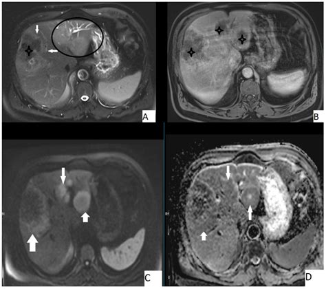 Pathogens Free Full-Text Imaging Aspects of Hepatic Alveolar ...