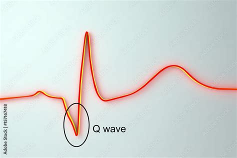 Pathological q wave
