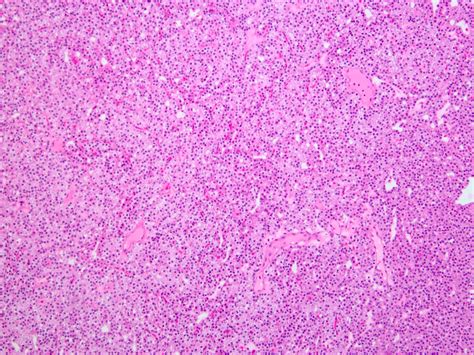 Pathology Outlines - Frozen section-parathyroid