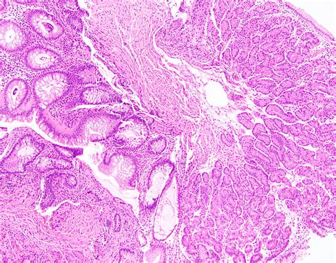 Pathology Outlines - Gastric heterotopia