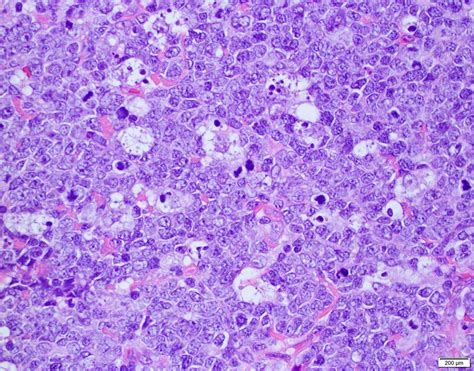 Pathology Outlines - Pediatric type