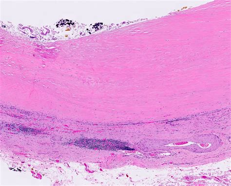 Pathology Outlines - Porcelain gallbladder