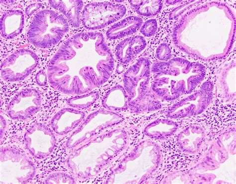 Pathology Outlines - Serrated polyp