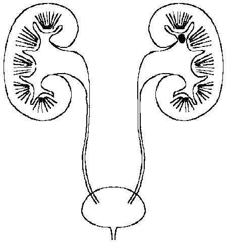 Pathology Outlines - Urolithiasis (stones)