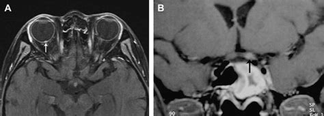 Pathology of the Optic Nerve Radiology Key