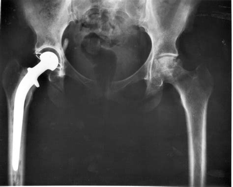 Patients expected Profemur artificial hips to last. Then they snapped in half