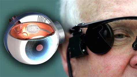 Patients guide to the bionic eye patients guide to the bionic eye. - Introduction to real analysis solutions manual.