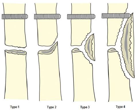 Pattern of Cortical Fracture following Corticotomy for Distraction ...