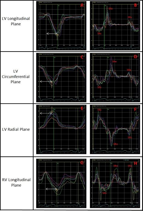 Patterns of Left Ventricular Longitudinal Strain and Strain Rate in