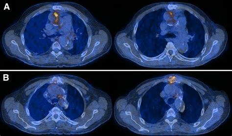 Patterns of vascular graft infection in 18F-FDG PET/CT - PubMed