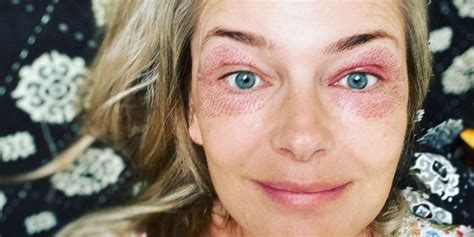 Paulina Porizkova Shows Off Her Eyes After Plasma Pen …