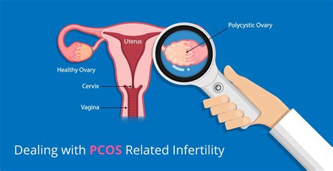 Pcod is curable