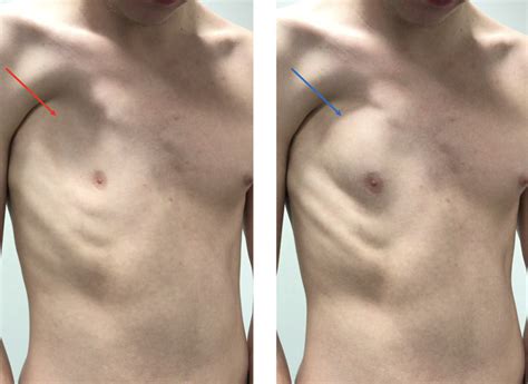 Many conditions can cause a lump on the chest. Some are benign