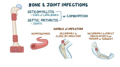 Pediatric Bone and Joint Infections - Children