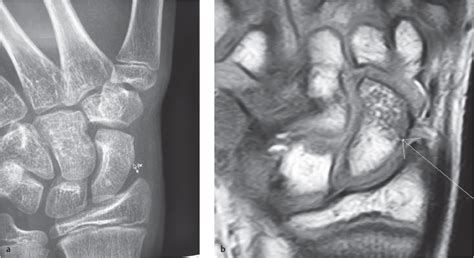 Pediatric Hand Fractures Musculoskeletal Key