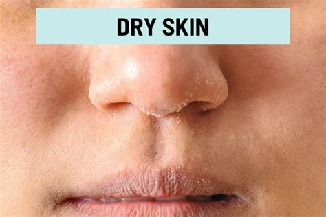 Peeling Skin On Nose: Its Causes & Natural Ways To Get Rid ...