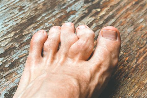 Pegloticase Safe, Effective for Refractory Gout in …