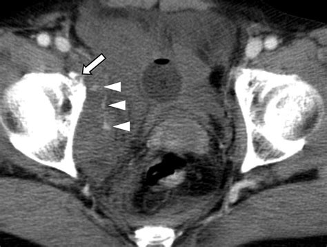 Pelvic Arterial Hemorrhage in Patients with Pelvic ... - RadioGraphics