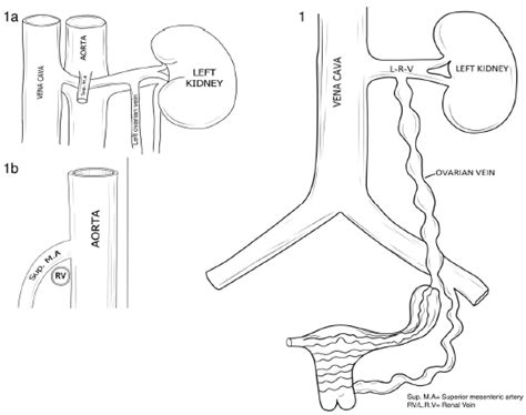 Pelvic Congestion Syndrome - Physiopedia