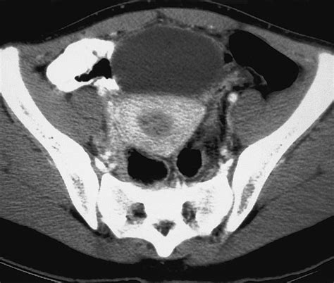 Pelvic Inflammatory Disease: Spectrum of Imaging Findings