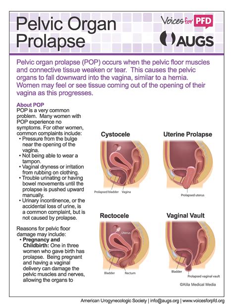 Pelvic Organ Prolapse-Urinary Incontinence Sexual Function ...