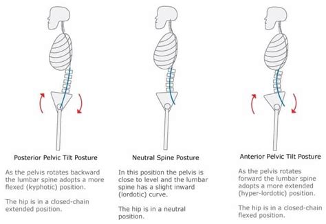 Pelvic pressure.  Slowly return to starting position while maintaining pelvic tilt.  Evaluate t...