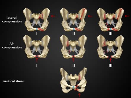 4-th or 5-th digit required · S32.811 Multiple fractures of pelvis with unstable disruption of pelvic ring.. 