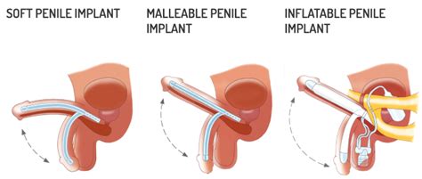 Penile implants