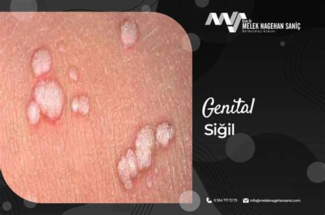 Penis Siğil Tedavisi.