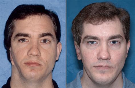 People with facial deformities.  Over time, the soft tissue Virtual Cranio...