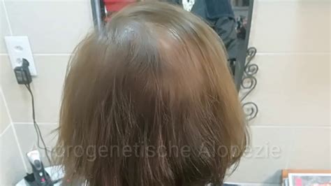 Perücke vs. Alopezie: Die beste Lösung für Ihr Haarproblem