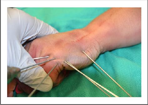 Percutaneous Pinning of Fifth Carpal–Metacarpal …