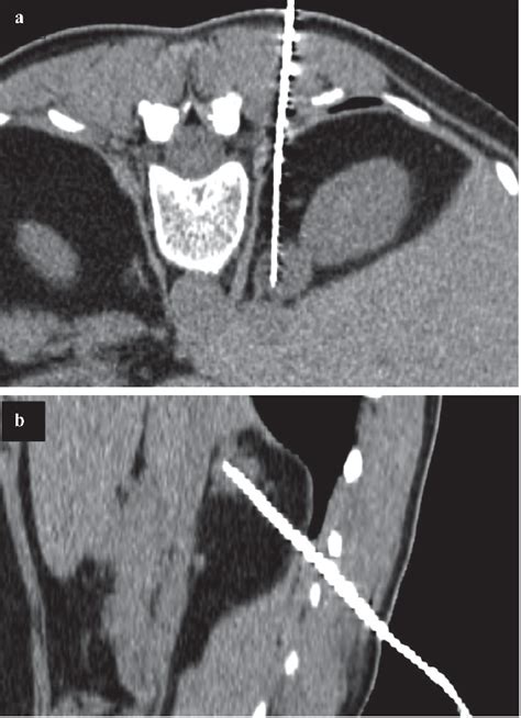 Percutaneous needle biopsy of retroperitoneal lesions: technical ...