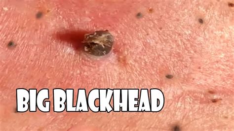 Perennial blackheads. Removing super hard perennial blackheads on the face of a sixty-year-old man 