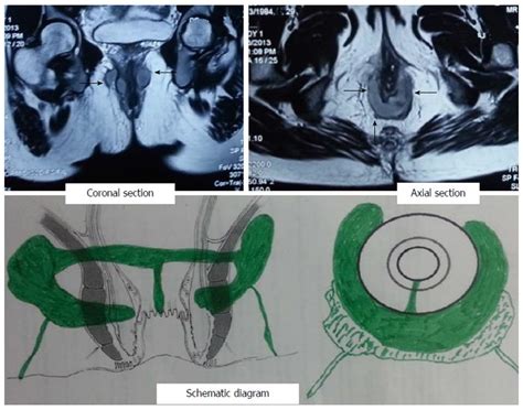Perfact procedure for fistula. .  ...