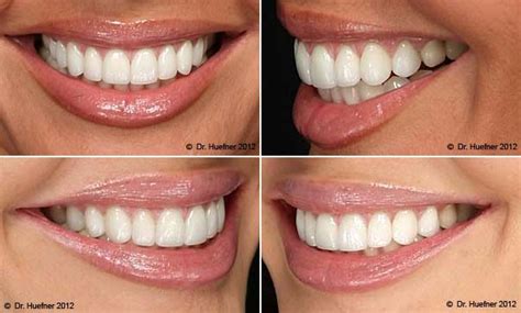 Perfect Porcelain Veneer Tooth Shapes For Your New Smile