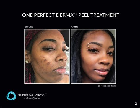 Perfect derma peel. The Perfect Derma ™ Peel Facial. Includes: Cleanse, degreasing of the skin using prepping solution, simple application of layering peel evenly along the face and neck. Afterwards your skin will feel tight/dry for 1-3 days and you will start peeling within 3-4 days. The peeling process will last up to 1.5 weeks. 