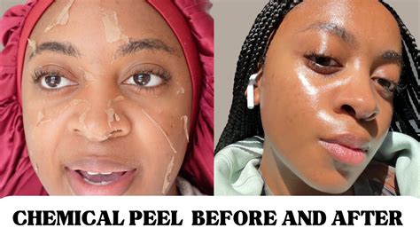 Perfect peel. Apr 27, 2016 · Here are five more reasons to book a peel—and help your skin make a radical comeback. Peels can make your skin—and skin-care products—work better. In minutes, acids lift away dead cells and ... 