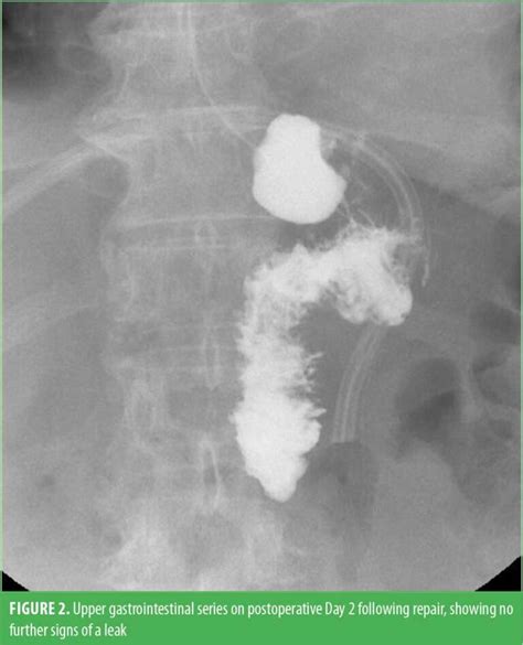 Perforated Marginal Ulcer Secondary to Marijuana Smoking