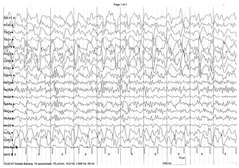 Periodic lateralized epileptiform discharges seen in the left