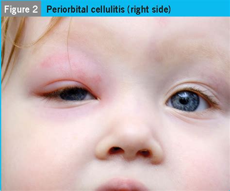 Periorbital cellulitis in children: Analysis of outcome of ... - PubMed