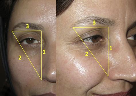 Periorbital facial rejuvenation; applied anatomy and pre