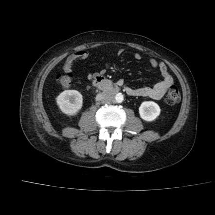 Peripheral T cell lymphoma Radiology Reference Article Radiopaedia.org