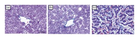Perisinusoidal fibrosis stage.  Background & Aims:Significant liver fibrosis (F P2) and po...
